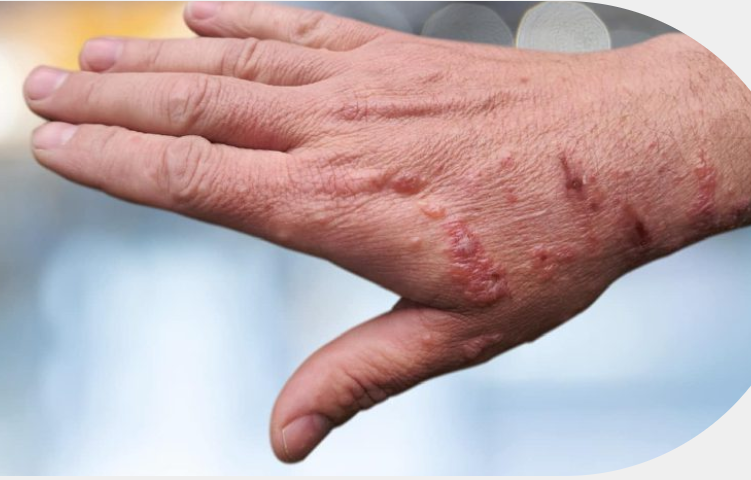 Image of a hand with a chemical burn