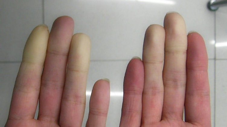 Fingers with HAVS (hand-arm vibration syndrome)