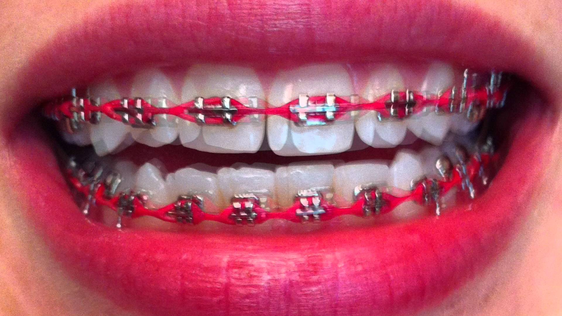 Image of Orthodontic Braces