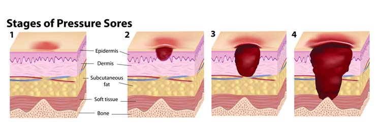 Stages of Pressure Sores