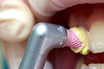 paste dental prophy polish gels